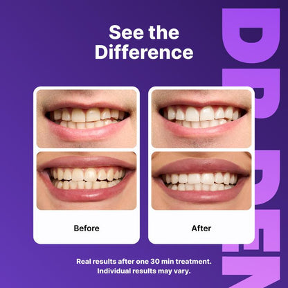 Dr. Dent Purple Teeth Whitening Strips – Fast Results, Zero Sensitivity